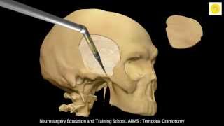 Neurosurgery 3D Animation Video  Temporal Craniotomy [upl. by Rehoptsirhc]