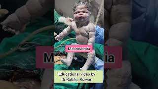 Good size baby  Macrosomia  Newborn with Five kg weight  baby  diabetes  knowledgefacts [upl. by Aynotahs]