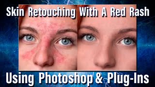 Retouching skin with a bad rash in Adobe Photoshop [upl. by Ecydnak]