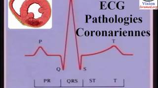 Interprétation de LÉlectrocardiogramme ischémie et infarctus du myocarde [upl. by Ardnwahs58]