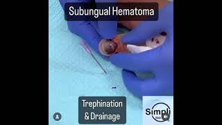 Subungual Hematoma Trephination [upl. by Seline379]