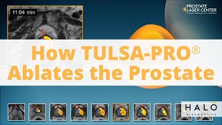 How TULSAPRO TransUrethral Ultrasound Ablation procedure Works as a Prostate Cancer Treatment [upl. by Anesuza]