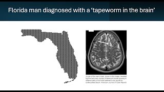 Florida man diagnosed with a tapeworm in the brain [upl. by Canica11]