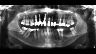 für Zahnärzte das OPTG Röntgen [upl. by Eachelle839]