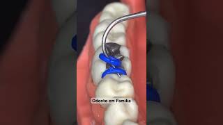 Separadores  Banda Ortodôntica 😬😄 viralvideo dentista dentes shortsvideo odontologia asmr [upl. by Ahseihs]