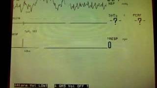 Asystole Apnea alarms [upl. by Sall]