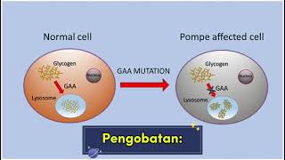 Pompe disease [upl. by Juieta814]