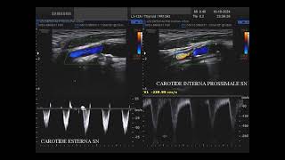 stenosi dellarteria carotide interna sinistra  ICA [upl. by Rillis874]