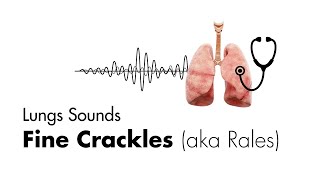 Fine Crackles Rales  Lung Sounds  MEDZCOOL [upl. by Abita]