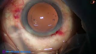 Prechopping is the way to go in Soft Cataracts  slow motion at the end of this video  P Mohanta [upl. by Eran]