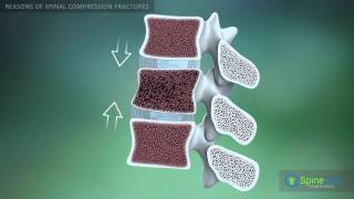 Spinal Compression Fracture Reasons [upl. by Staford]