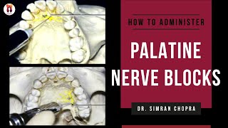 Palatal Anesthesia Techniques l Greater Palatine Nerve Block l Nasopalatine Nerve Block [upl. by Alletnahs]