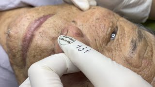 Collection of the best acne treatment videos of a 90 year old gentleman [upl. by Pacian907]