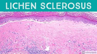 Lichen Sclerosus et atrophicus Inflammatory Dermpath Basics for Dermatology amp Pathology [upl. by Artapoelc321]