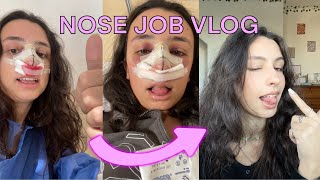 NOSE JOB and DEVIATED SEPTUM VLOG my septorhinoplasty recovery  tips [upl. by Fasto]