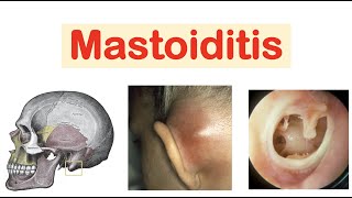 Mastoiditis amp Acute Otitis Media  Causes Pathophysiology Symptoms Diagnosis Treatment [upl. by Mellman75]