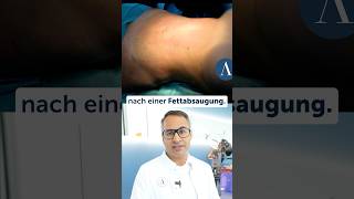 fettabsaugung fettabbau fettabnehmen plastischechirurgie düsseldorf [upl. by Ahtnamys]