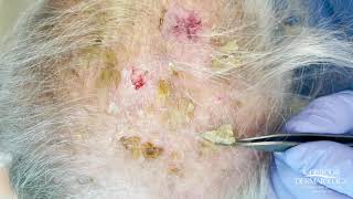 Debulking Lesions on the Scalp Erosive Pustulosis of the Scalp  CONTOUR DERMATOLOGY [upl. by Beitnes]