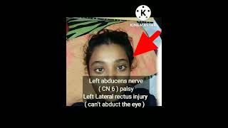 Left abducens nerve  CN 6  palsy [upl. by Alhahs386]