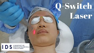 Q Switch Laser Before and After  IDS Clinic Review [upl. by Aem]