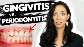 Do You Have Gingivitis or Periodontitis  Different Stages Of Gum Disease [upl. by Alysia]