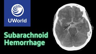 Subarachnoid Hemorrhage amp Treatment  nimodipine USMLE STEP 1 UWORLD Questions Nervous system [upl. by Yramliw255]