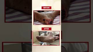 See the Amazing Transformation Before amp After Angioplasty Blood Flow Angioplasty angioplasty [upl. by Calabrese]