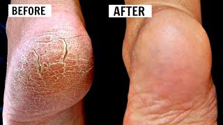 CRACKED HEELS HOME REMEDIES  HOW TO CURE CRACKED amp DAMAGED FEET  OMABELLETV [upl. by Aicad]