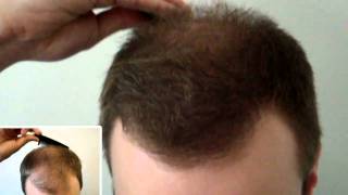 Thickening hair in frontal and top scalp [upl. by Haidej]