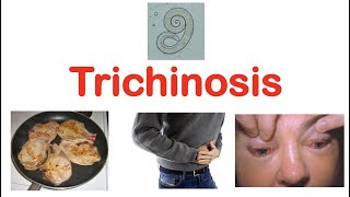 Trichinosis Pork Parasite  Pathophysiology Signs amp Symptoms Diagnosis Treatment [upl. by Ennairam]