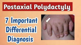 Postaxial Polydactyly Causes  Pediatrics Hand Dysmorphism  Part 1 [upl. by Caroline]