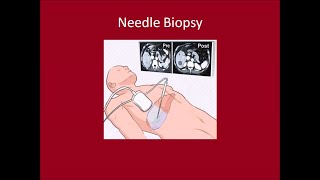 Ultrasound Guided Liver Biopsy [upl. by Reggi]