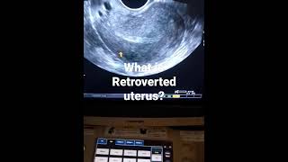 what is Retroverted uterusand how looks on tvs ultrasound [upl. by Acirea]