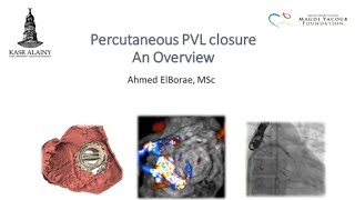 Percutaneous paravalvular leak closure [upl. by Mccall802]