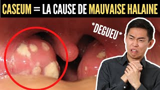 🔴La Solution AntiMauvaise Haleine causée par ces Boules Blanches Puantes CASEUM [upl. by Ajay]