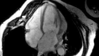 Cardiac MRI Vertical long axis view [upl. by Noni]