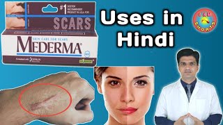 Mederma cream  mederma for acne scars  mederma advanced scar gel review [upl. by Ataynek]