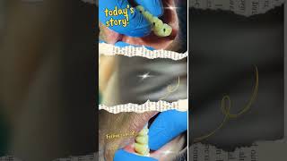 Follow Me For Full Implants installation Procedure insiders craft health shortsshortfeed [upl. by Olin]