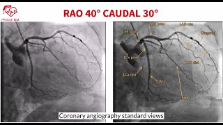 Coronary angiography standard views [upl. by Kenleigh]