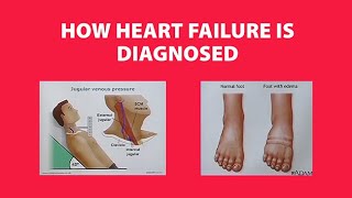 How Heart Failure is Diagnosed [upl. by Airtal]