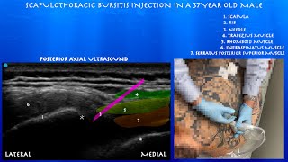 Ultrasound Guided Scapulothoracic Bursa Injection by probeultrasound [upl. by Nirad]