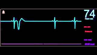 11 Extrasistole ventricular [upl. by Duffie]