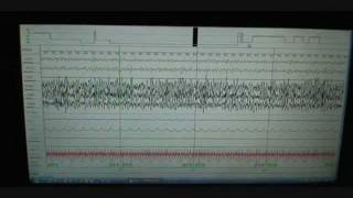 Sleep Study Scoring on Person with Normal Sleep Polysomnograph [upl. by Ilecara]