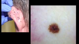 Homogenous blue lesions and many faces of metastatic melanoma by Dr A Marghoob [upl. by Illib]