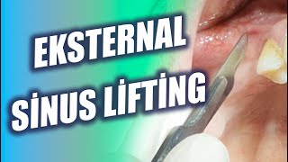 Eksternal Sinus Lifting Operasyonu  Sinus Lift Surgery [upl. by Oech]