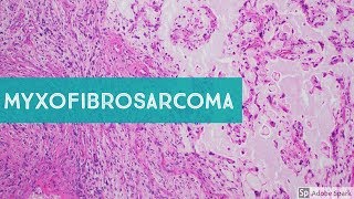 Myxofibrosarcoma 101Explained by a Sarcoma Pathologist [upl. by Clare]