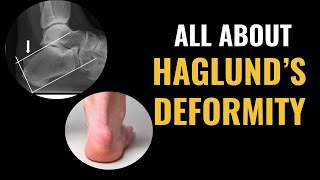 How Do I Treat A Haglunds Deformity [upl. by Anadal]