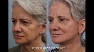 Deep Plane Facelift Before And After  Patients advice quotDont Waitquot [upl. by Fabrianna]