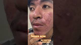 Severe acne treatment by Dr makara [upl. by Hgielra839]