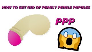 Get Rid Of Pearly Penile Papules  How I Cured Of Pearly Penile Papules [upl. by Munroe]